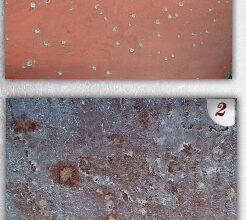 The boat was a 1979 Morgan 461 sloop that had spent nearly her entire life immersed in tropical waters. While sanding the thick buildup of bottom paint, the crew discovered many hundreds of tiny blisters. They first tried opening each one with a Dremel tool and waiting for the laminate to dry (PHOTO 1). The original plan was to “spot fill” these blisters using epoxy filler. However, when moisture levels failed to come down significantly after several weeks, an exploratory removal of the gelcoat was in order. That revealed a bigger problem (PHOTO 2).