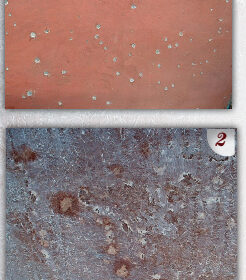 The boat was a 1979 Morgan 461 sloop that had spent nearly her entire life immersed in tropical waters. While sanding the thick buildup of bottom paint, the crew discovered many hundreds of tiny blisters. They first tried opening each one with a Dremel tool and waiting for the laminate to dry (PHOTO 1). The original plan was to “spot fill” these blisters using epoxy filler. However, when moisture levels failed to come down significantly after several weeks, an exploratory removal of the gelcoat was in order. That revealed a bigger problem (PHOTO 2).