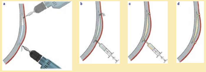 Deep fiberglass blisters are larger than gelcoat blisters and not as well-defined. The shortcut repair for a few blisters is to drill small holes top and bottom (a), drain each blister, flush with alcohol (b), inject epoxy from the bottom (c) to force air out, and seal the entry holes (d).
