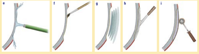 Once you have arrived at clear fiberglass, wash and scrub the cavity with fresh water (e) several times. Allow the hull to dry out before continuing. After another washing and drying spell, coat the cavity with epoxy resin (f) and begin building the hole back with fiberglass patches (g). Next fair the hull with epoxy putty (h), sand, and add a barrier coat (i).